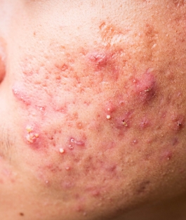 Acne Treatment