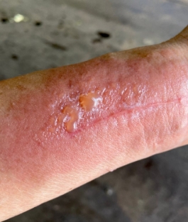 Dermatitis