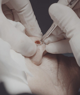 mohus treat img Mohs Surgery - 1