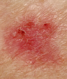 Skin Cancer