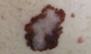 C3 Skin Cancers & Melanomas - 5