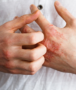 eczema treat img Medical Dermatology - 4