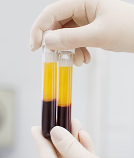 Platelet-rich Plasma (PRP) Therapy